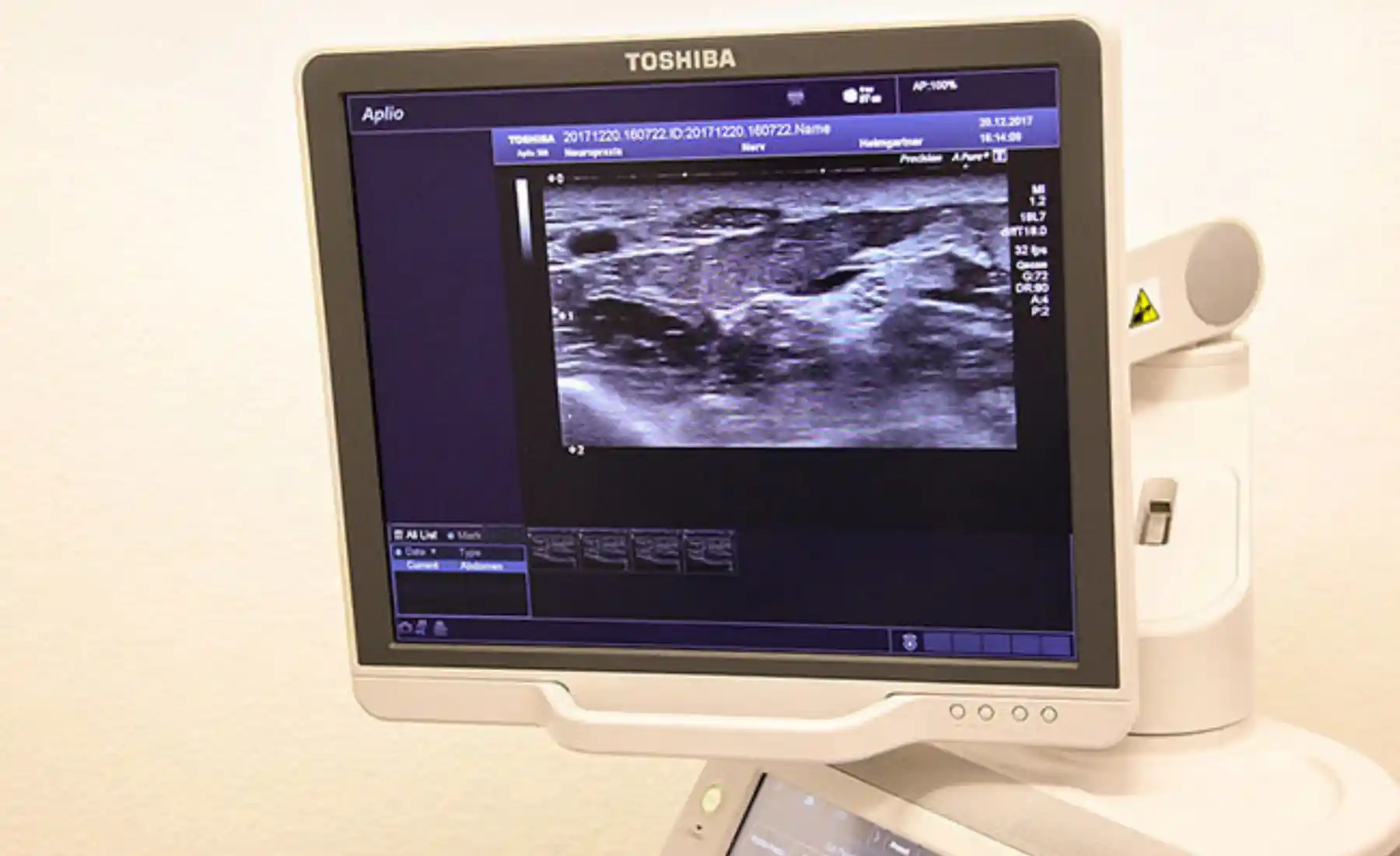 Sonographie Nerven Struktur Medianusnerv Neuromobil