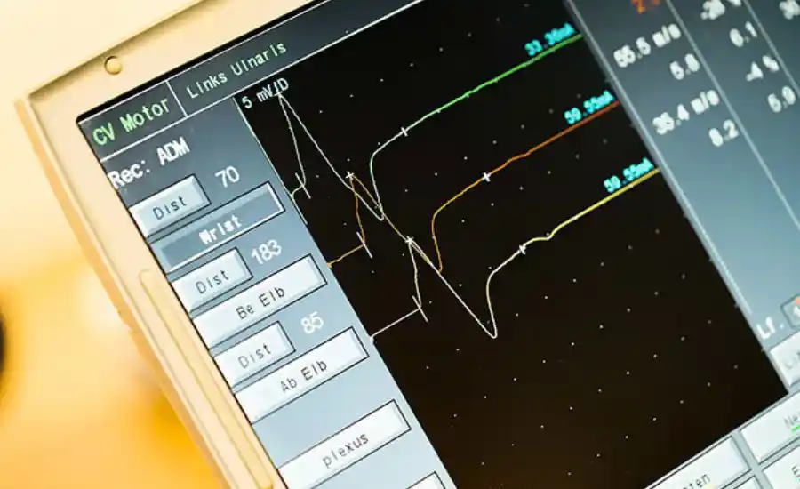 Messung Nervenleitgeschwindigkeit Beurteilung Neuromobil